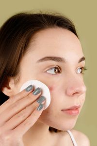 Ini 7 Cara Menghilangkan Jerawat di Kening, Nomor 5 Seringkali Dibiarkan 
