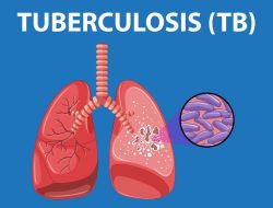 Kasus TBC di Blitar Meningkat, 93 Penderita Meninggal dalam Setahun